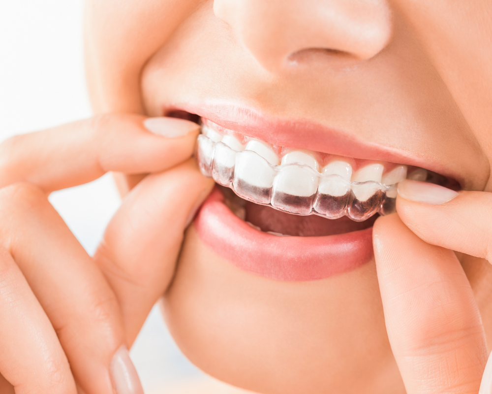 Aparelho invisível (Invisalign): como funciona e para quem é indicado?